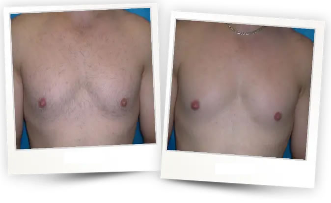 Antes x Depois - Depilação a Laser 1