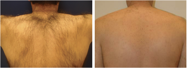 Antes x Depois - Depilação a Laser 3