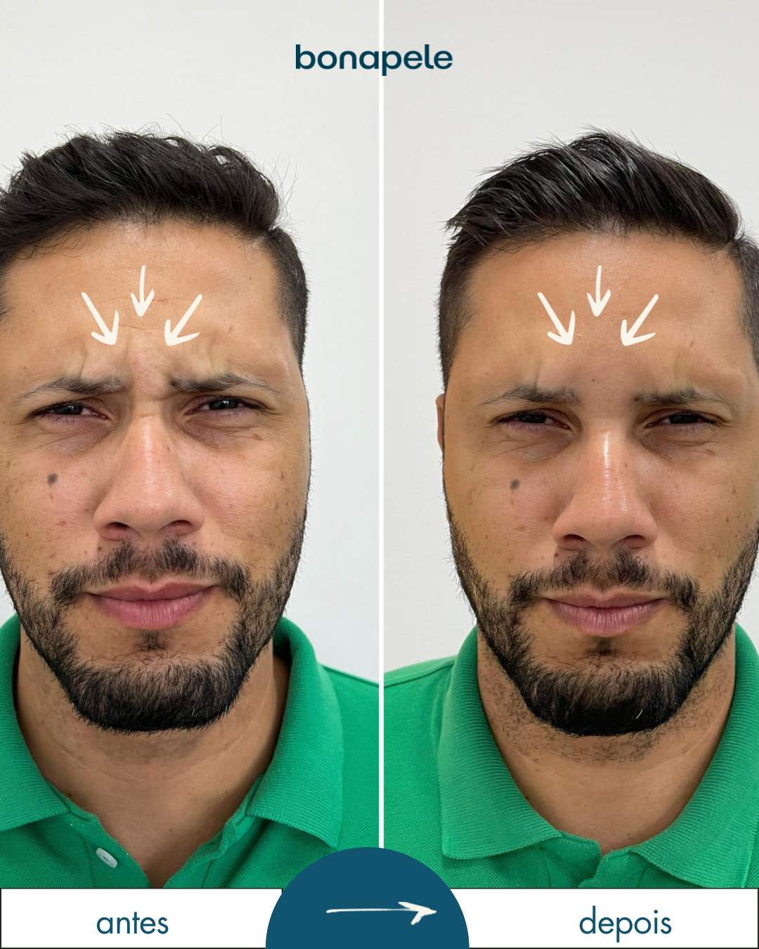 1.3-ANTES E DEPOIS - botox - 13