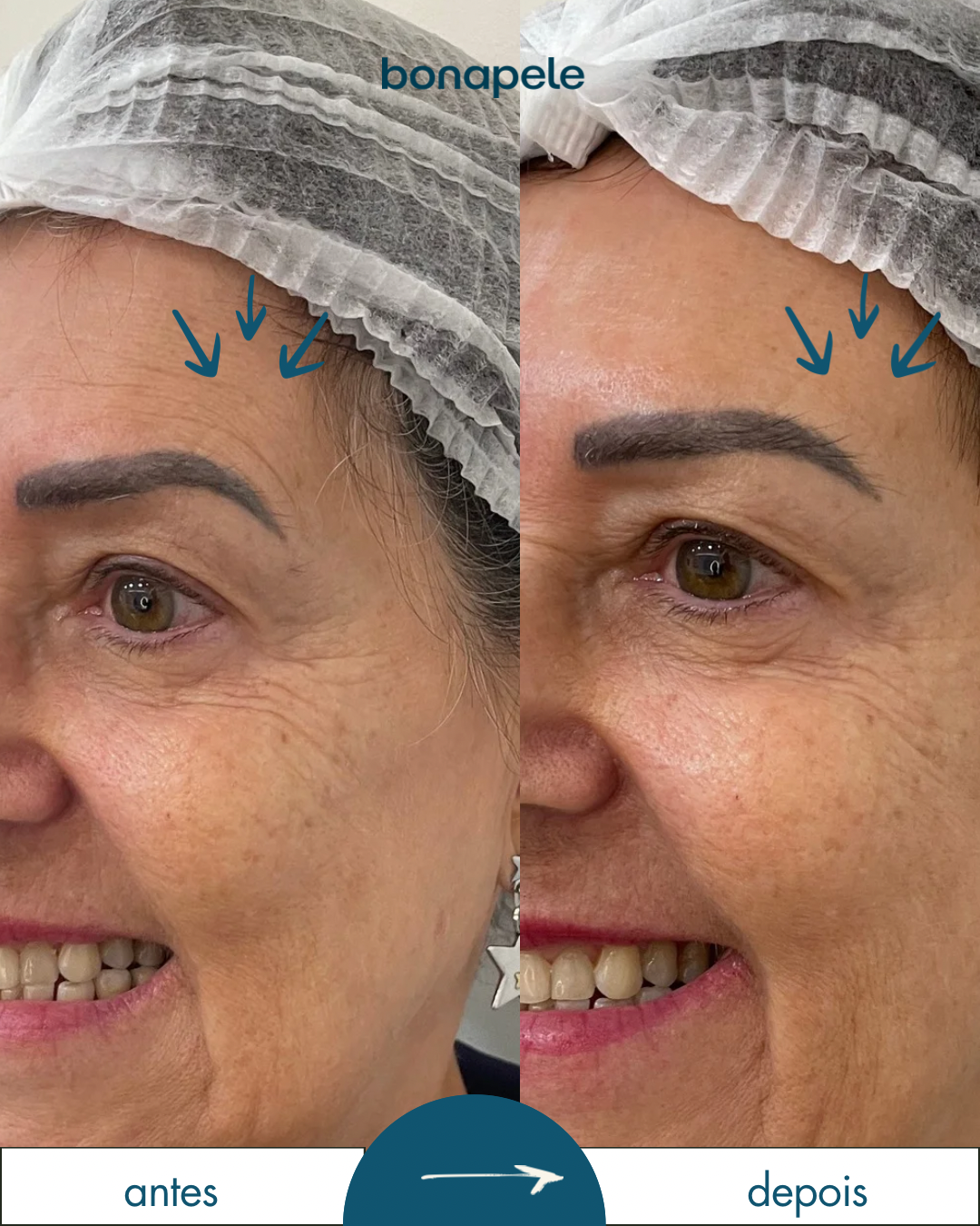 2.3-ANTES E DEPOIS - botox - 21