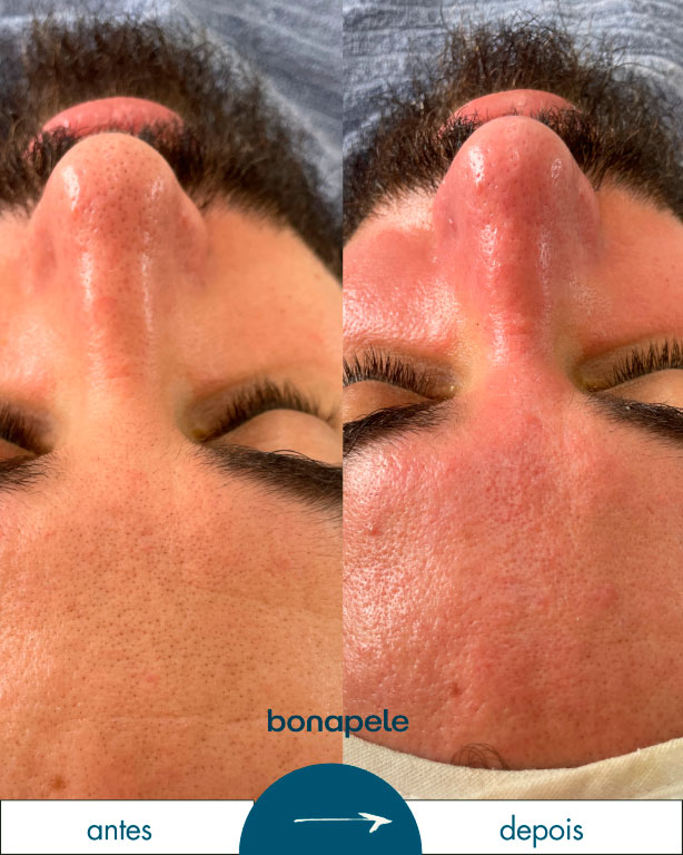 bonapela-antes-depois1