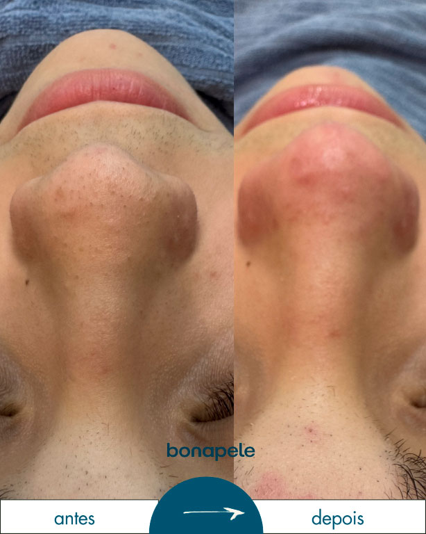 bonapela-antes-depois3