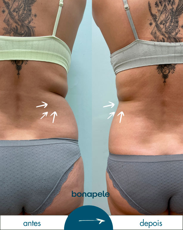 bonapela-antes-depois5