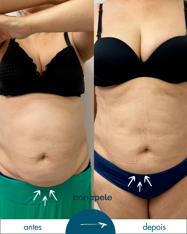 bonapela-antes-depois7