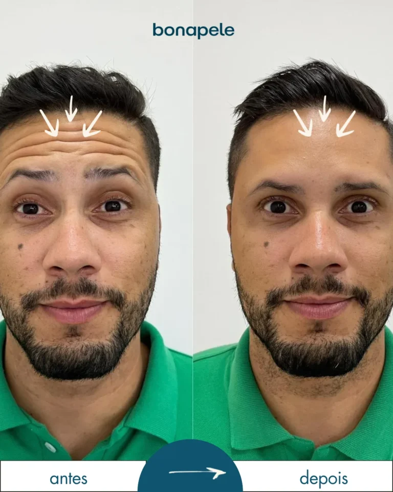 Botox na testa antes e depois | Bonapele Vila Clementino