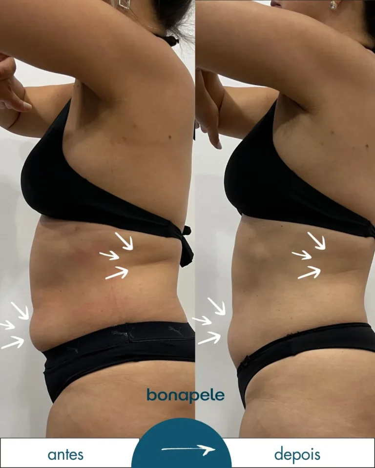 Antes e depois de criolipólise no abdômen após 3 sessões — Bonapele Vila Clementino