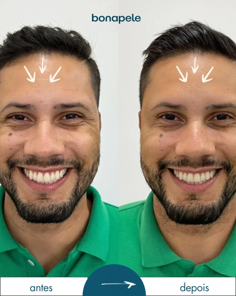 Botox na glabela antes e depois | Bonapele Vila Clementino