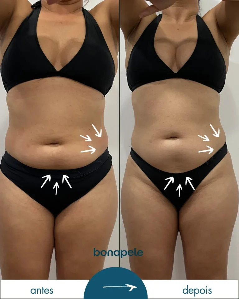 Antes e depois de criolipólise no abdômen após 3 sessões — Bonapele Vila Clementino