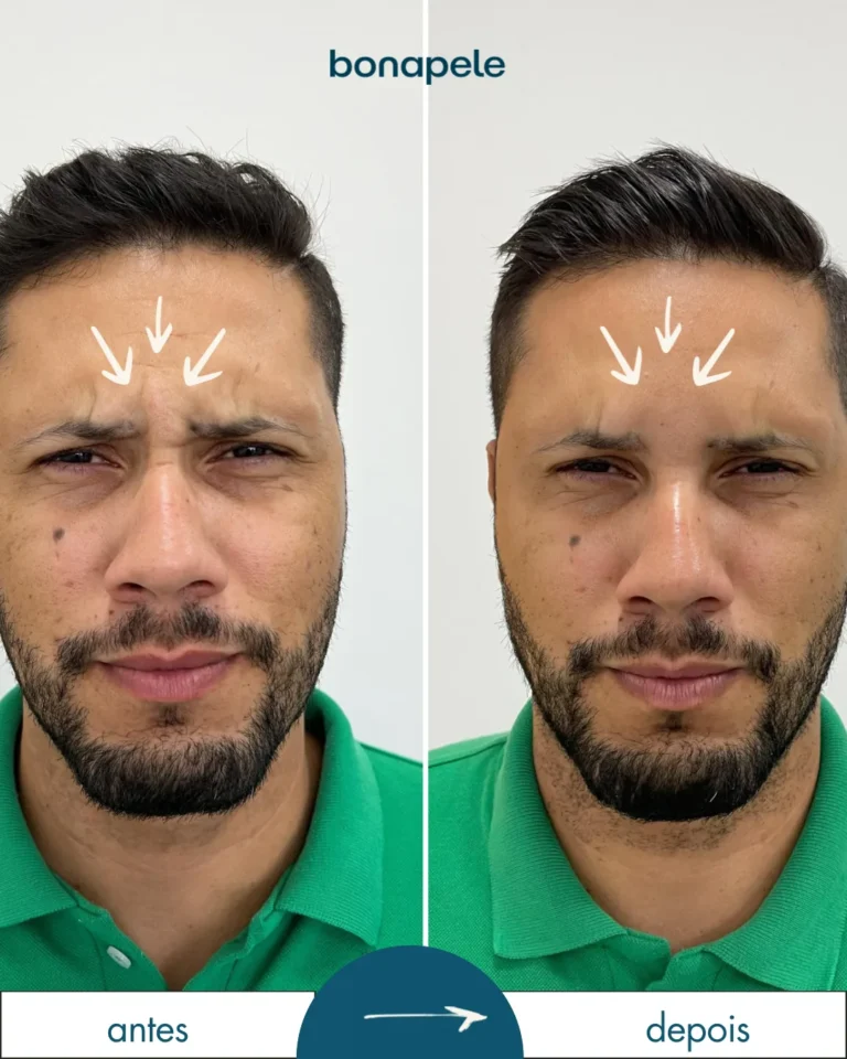 Botox na glabela antes e depois | Bonapele Vila Clementino