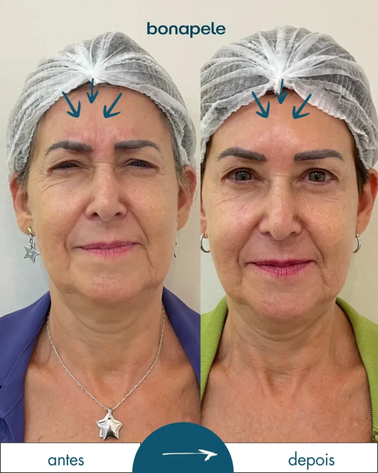 Botox na testa antes e depois | Bonapele Vila Clementino
