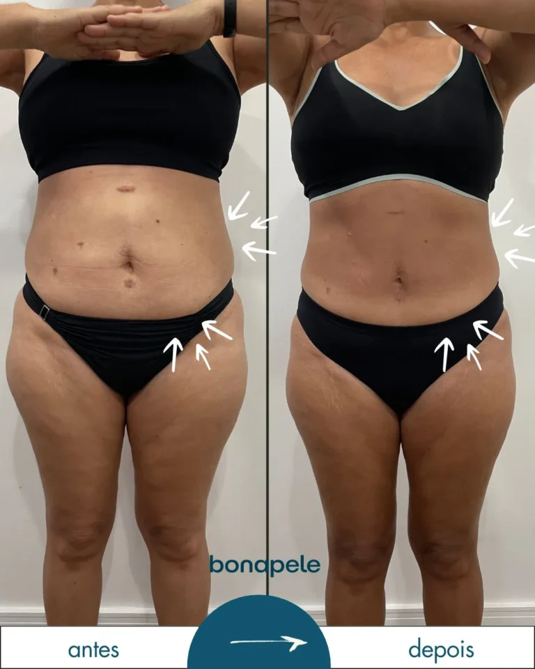 Antes e depois de criolipólise no abdômen após 3 sessões — Bonapele Vila Clementino