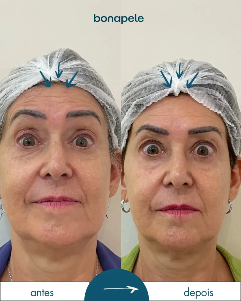 Botox na testa antes e depois | Bonapele Vila Clementino