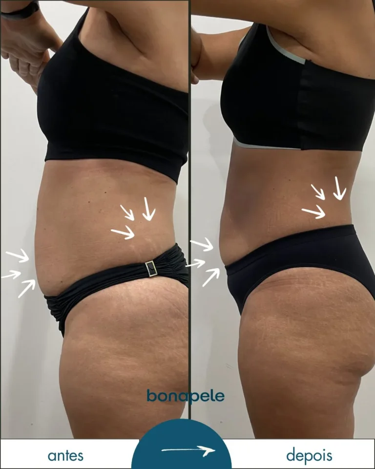 Antes e depois de criolipólise no abdômen após 3 sessões — Bonapele Vila Clementino