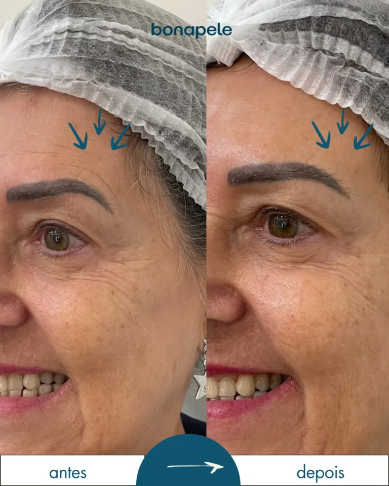 Botox nos pés de galinha antes e depois | Bonapele Vila Clementino