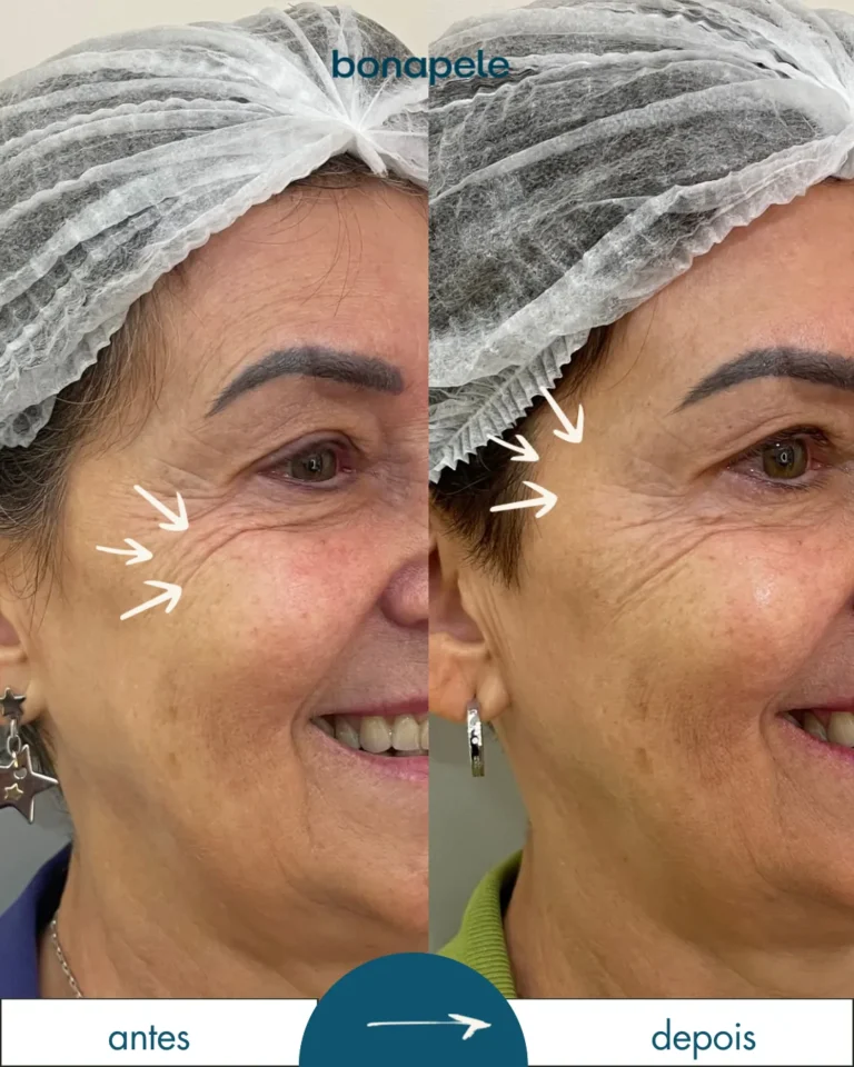 Botox nos pés de galinha antes e depois | Bonapele Vila Clementino