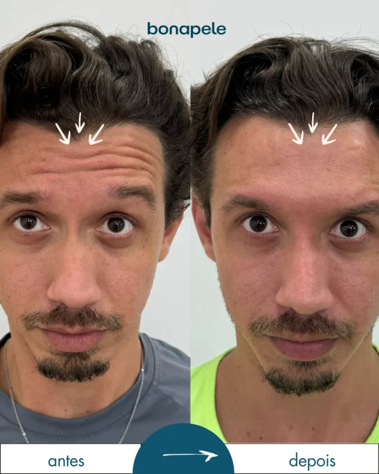 Botox na testa antes e depois | Bonapele Vila Clementino