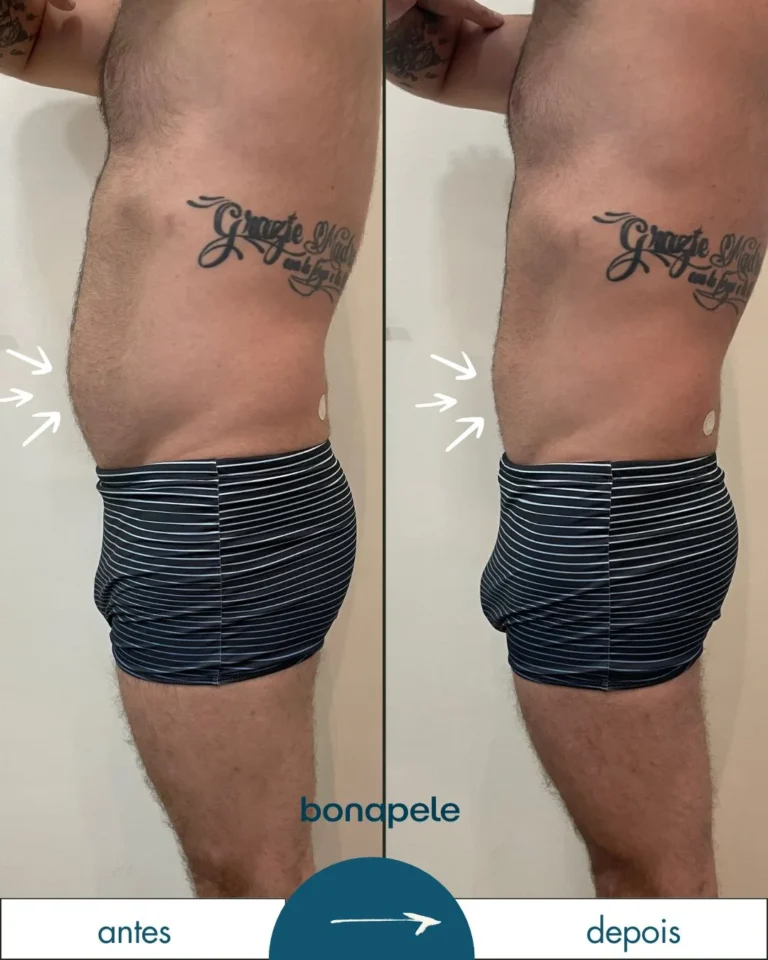 Antes e depois de criolipólise no abdômen após 3 sessões — Bonapele Vila Clementino