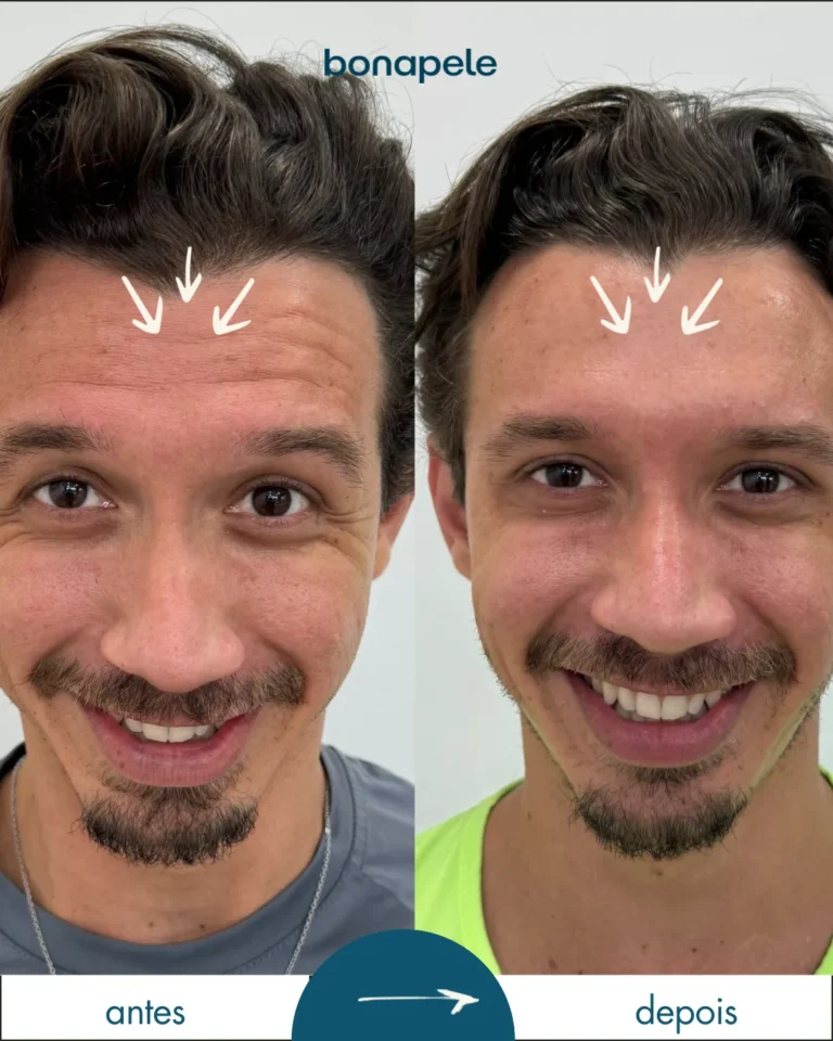 Botox na testa antes e depois | Bonapele Vila Clementino