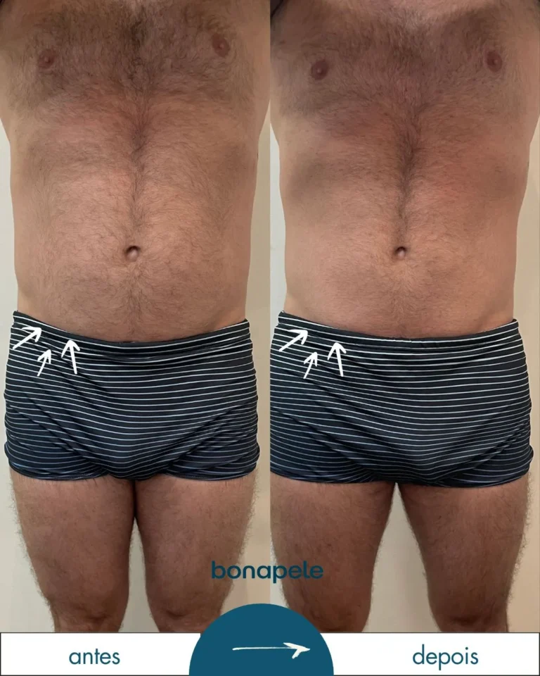 Antes e depois de criolipólise no abdômen após 3 sessões — Bonapele Vila Clementino