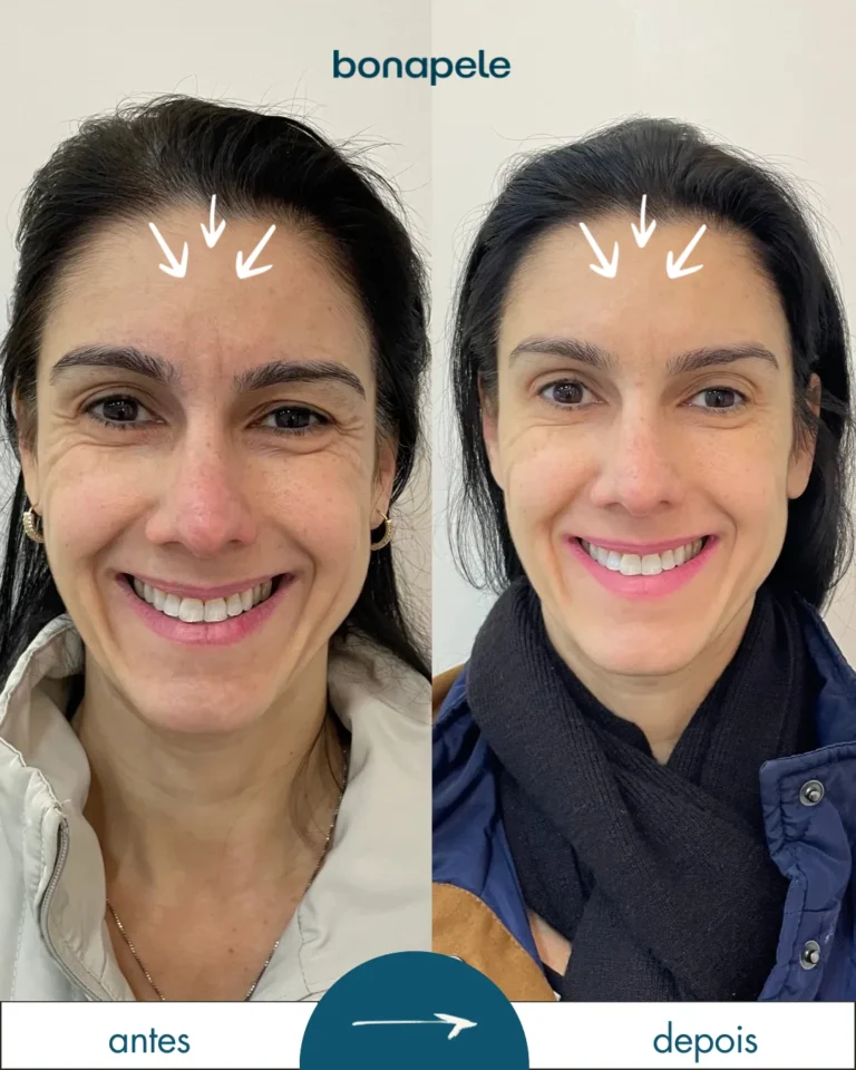 Botox na testa antes e depois | Bonapele Vila Clementino