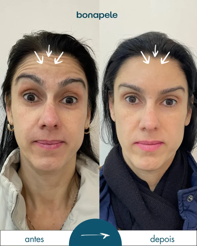 Botox na testa antes e depois | Bonapele Vila Clementino