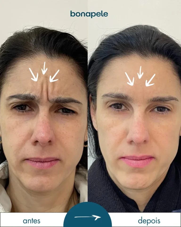 Botox na testa antes e depois | Bonapele Vila Clementino