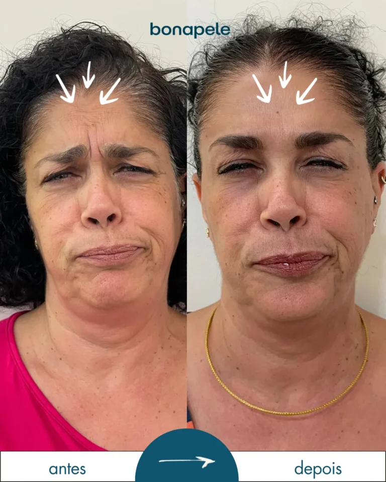 Botox na testa antes e depois | Bonapele Vila Clementino