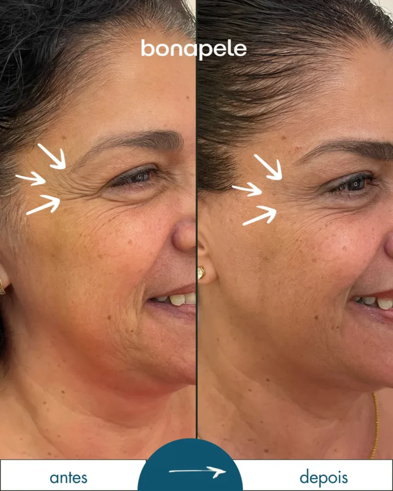 Botox nos pés de galinha antes e depois | Bonapele Vila Clementino