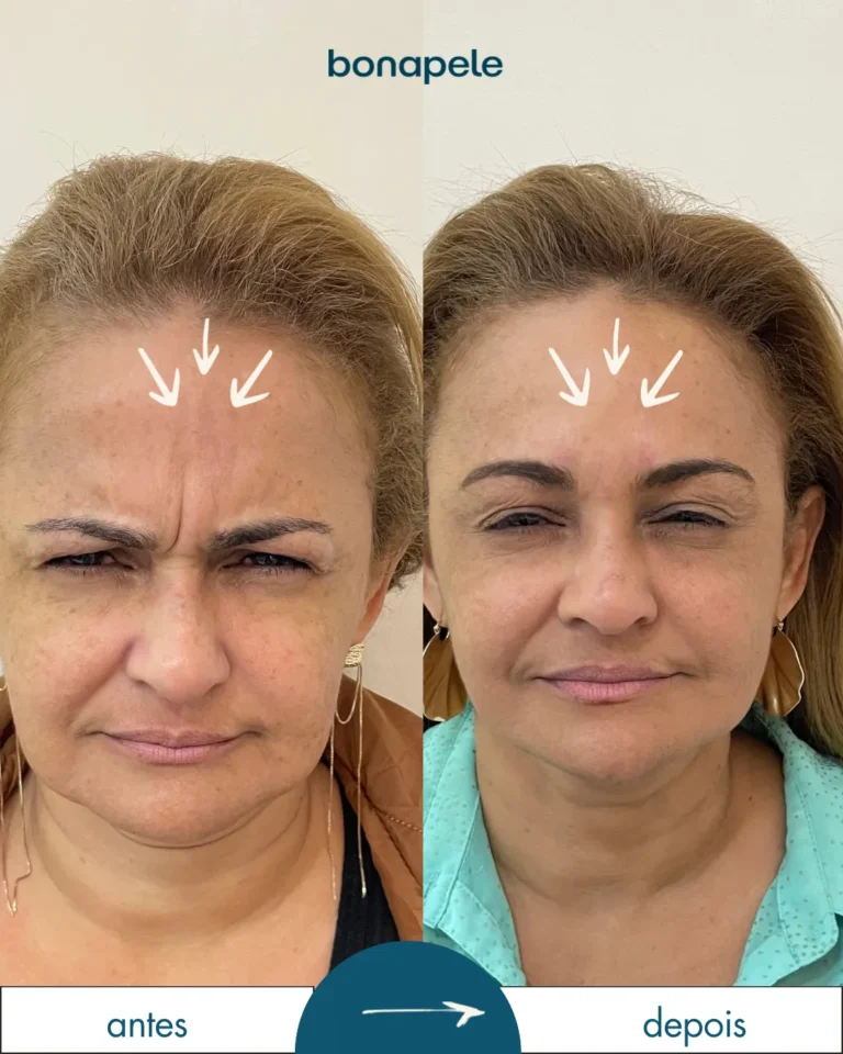 Botox nos pés de galinha antes e depois | Bonapele Vila Clementino