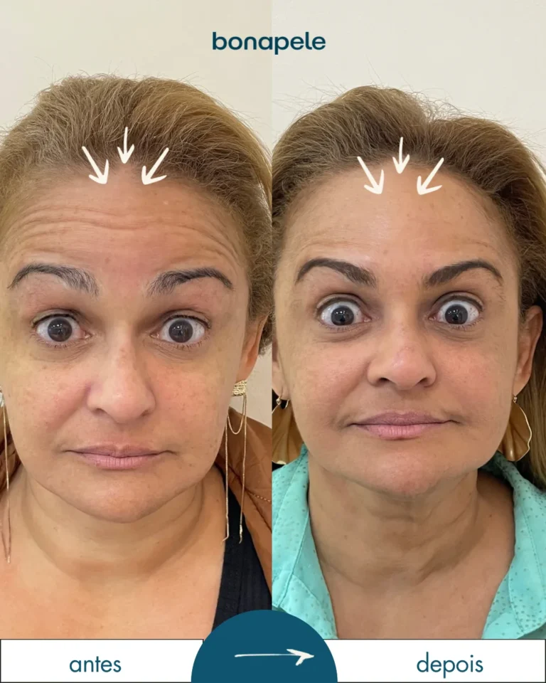 Botox nos pés de galinha antes e depois | Bonapele Vila Clementino