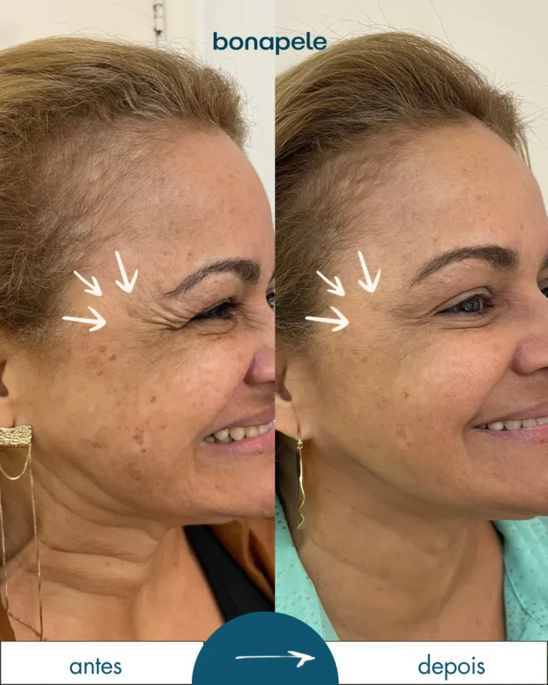 Botox nos pés de galinha antes e depois | Bonapele Vila Clementino