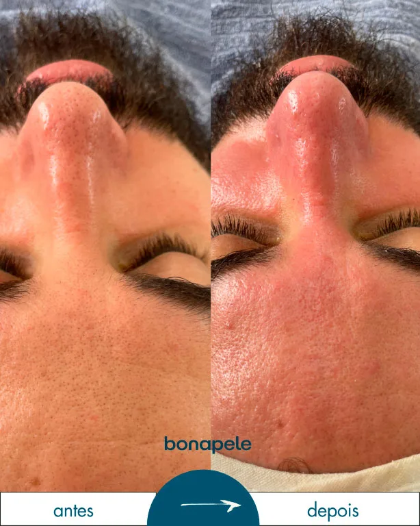 Bonapele Antes e Depois Limpeza de Pele 3