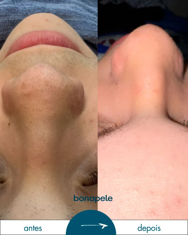 Bonapele Antes e Depois Limpeza de Pele 2