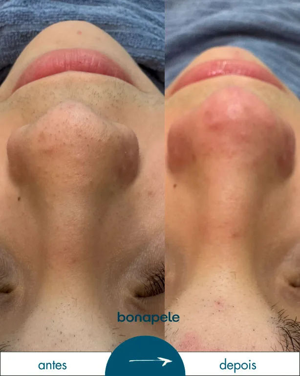 Bonapele Antes e Depois Limpeza de Pele 1
