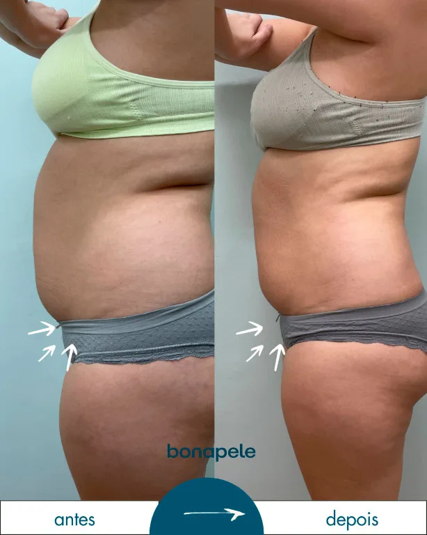 Antes e depois de criolipólise no abdômen após 3 sessões — Bonapele Vila Clementino