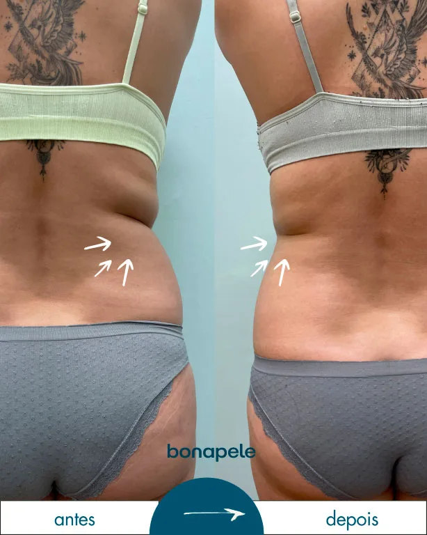 Antes e depois de criolipólise no abdômen após 3 sessões — Bonapele Vila Clementino