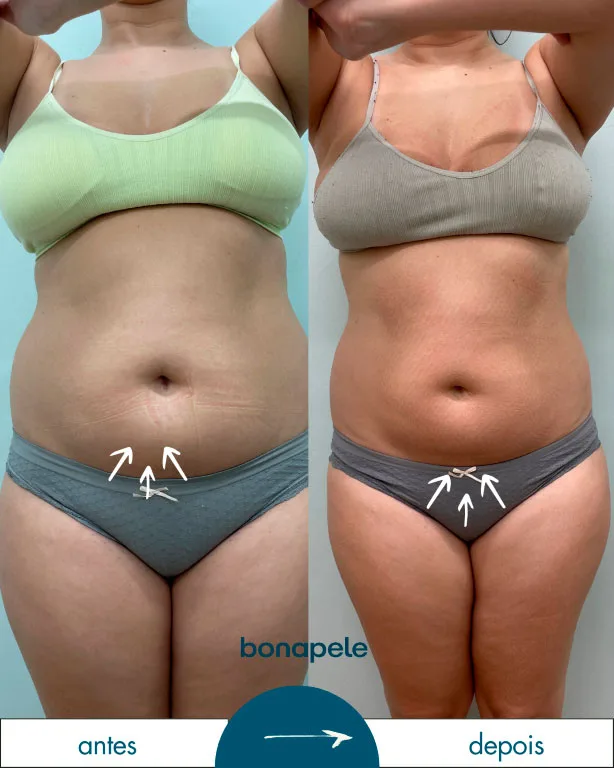 Antes e depois de criolipólise no abdômen após 3 sessões — Bonapele Vila Clementino