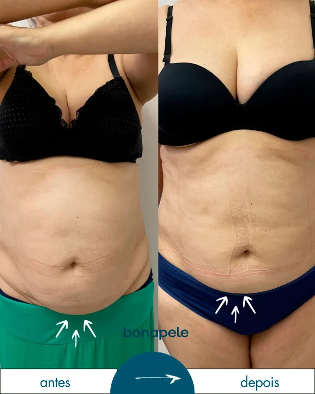 Antes e depois de criolipólise no abdômen após 3 sessões — Bonapele Vila Clementino